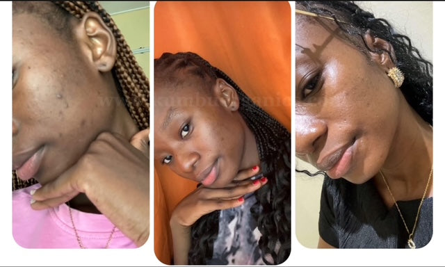 Kũmbu Organics | Acne/Dark Spots Eraser Face Kit