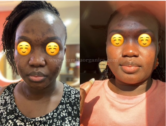 Kũmbu Organics | Acne/Dark Spots Eraser Face Kit