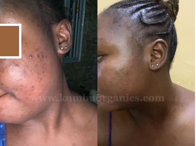 Kũmbu Organics | Acne/Dark Spots Eraser Face Kit