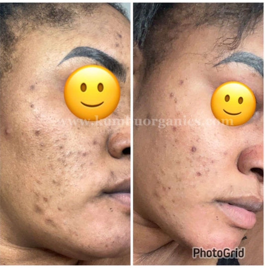 Kũmbu Organics | Acne/Dark Spots Eraser Face Kit